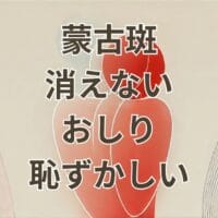蒙古斑 消えない おしり 恥ずかしい悩みを説明するイメージ